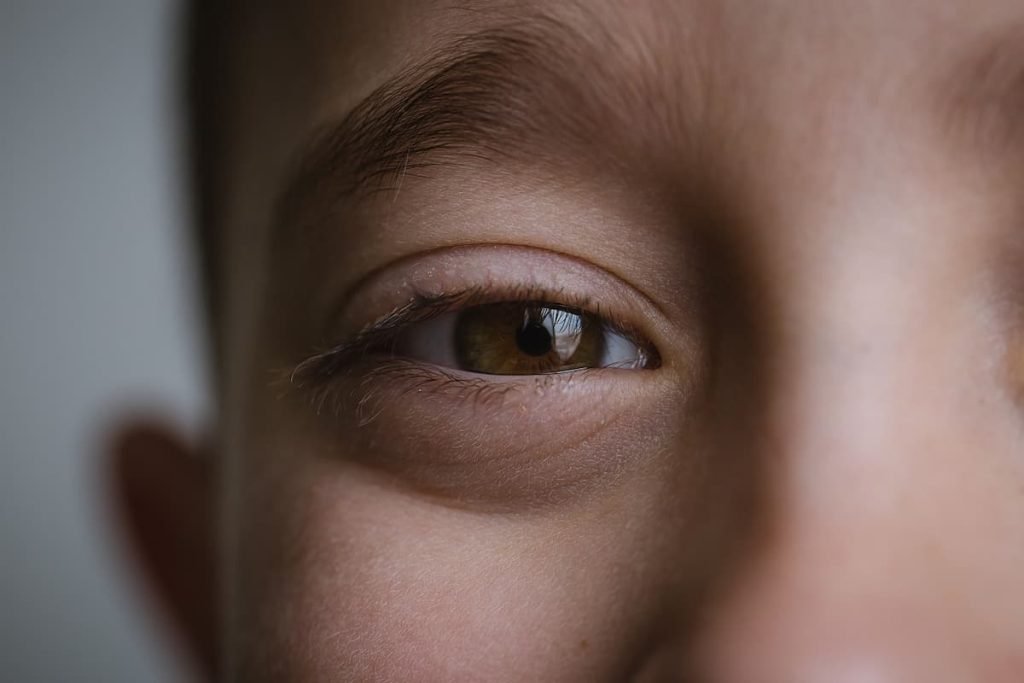 A catarata é a opacificação do cristalino, uma lente que temos nos olhos. É uma das principais causas de cegueira tratável na infância. Dependendo da idade de aparecimento, pode ser: