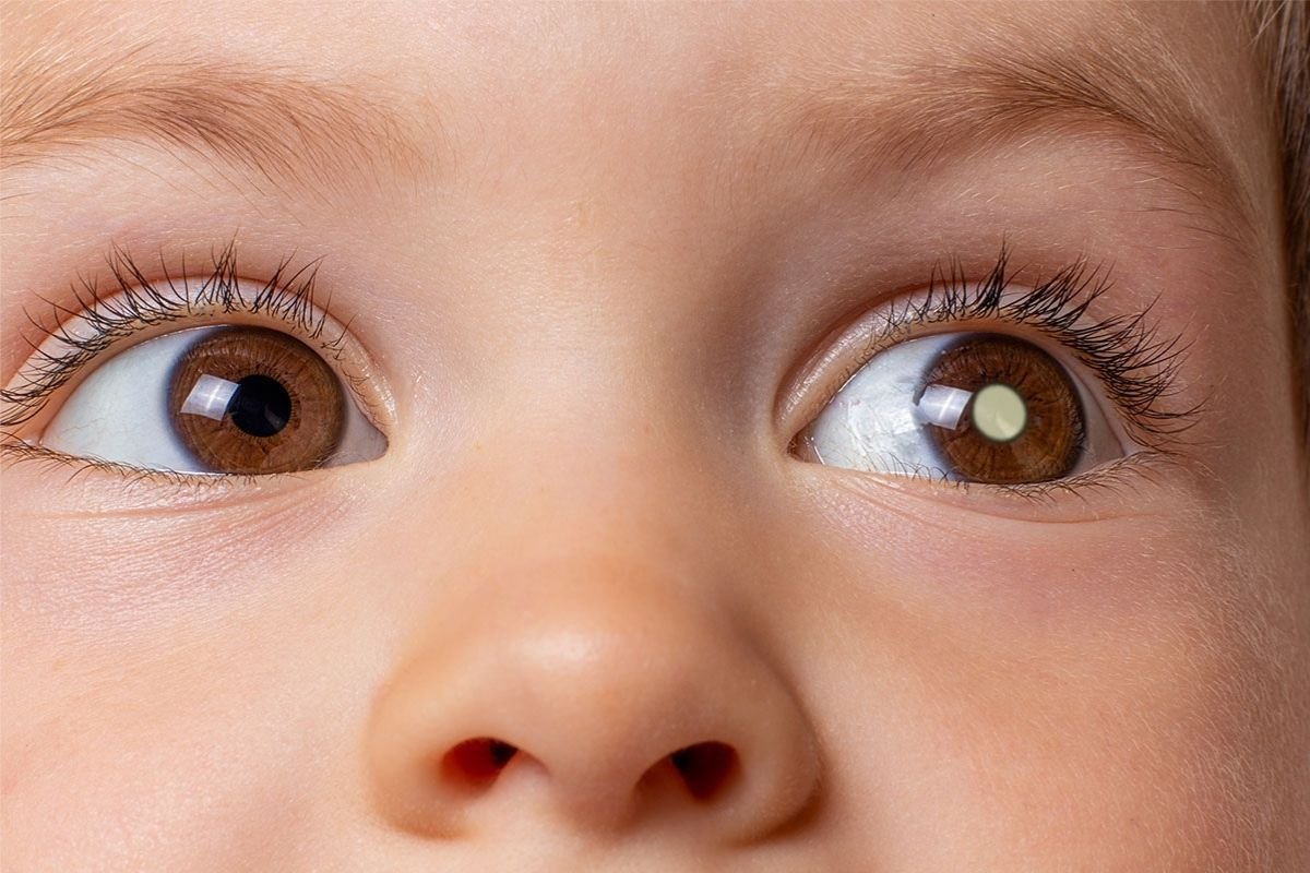 O retinoblastoma é o câncer ocular mais comum em crianças. A doença se desenvolve a partir de células da retina, a parte do olho responsável pela visão. Embora possa parecer assustador, o diagnóstico precoce em Brasília e o tratamento adequado oferecem altas chances de cura e preservação da visão.